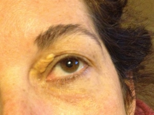 This is the second xanth I removed. You can see the scar from the first one under my eye.